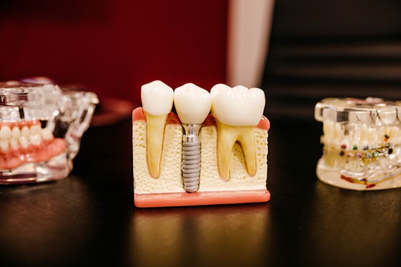 Modelo de implante dental sobre una mesa