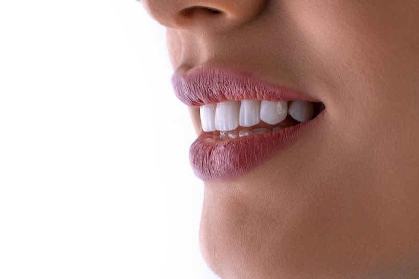 Primer plano de una sonrisa después del tratamiento